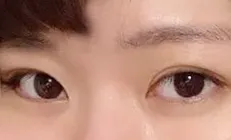 매몰+앞트임 한달차에용!!!!