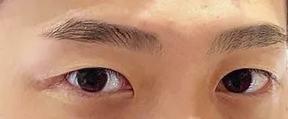 무쌍눈매교정 한달째