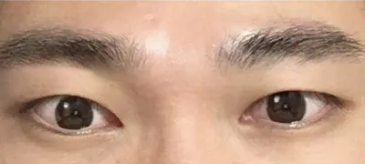 남자무쌍눈매교정