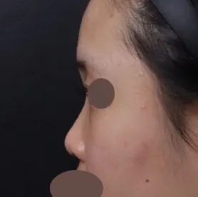 다들 베리굿성형외과에서 코성형하세욧!