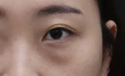 재수술이라 더 신중하게 발품을 여기저기 팔았으나, 최현정실장님과 김용우원장님이 설명을 꼼꼼히 잘해주시고 편안하게 해주셔서 결정하게 되었습니다.