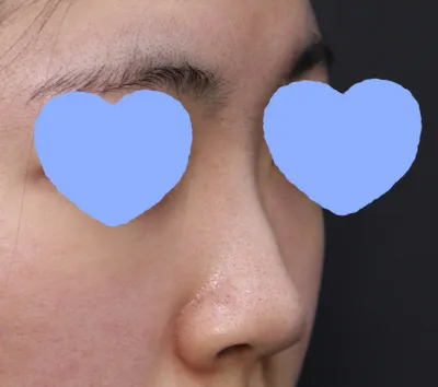 처음 상담 받으러 가자마자 너무 마음에 들어서 수술 날짜 잡고 예약금까지 걸고 왔지 뭐에요..^^