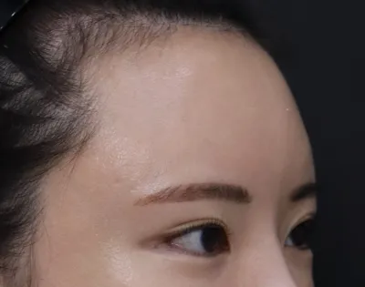 수술 당일엔 좀 아팠지만 효과가 있어서 너무 좋았어요!  눈이랑 눈썹 사이도 넓어지고 이마는 줄어들었어요~^^