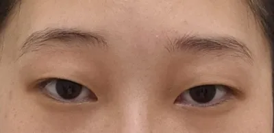 쌍수 고민하시는 분들은 여러군데 다니지 마시고 베리굿성형외과로 상담받으러오세용(ⓐⓐ) °◇°