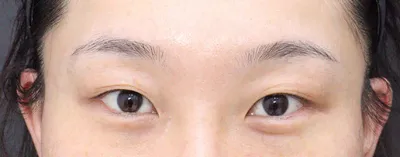 다른곳을 또  하게된다면 베리굿성형외과 먼저 와볼것같아요. 강추!!