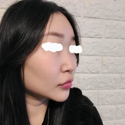 예쁜 코 만들어주신 임영민원장님 비염도 없애주신 남재성원장님  감사해용~