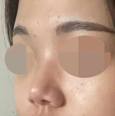짧은 코에 낮은 콧대 너무 신경쓰여서 수술 결정하게 되었습니다!