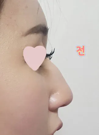 주변에서도 코 이쁘게 됐다고 다들 칭찬해줬어욤