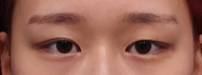 병원 내부도 깔끔하고 다 친절하셔서 부담없이 상담부터 수술 , 추후 관리까지 한거 같아요