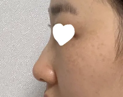 비염수술 하는김에 매부리있던거 정리하고   코수술 같이 진행 하게되었습니다