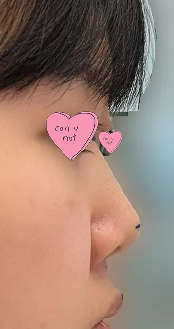 임영민원장님 믿고 수술하길 잘한것같아서 너무 추천드려요!