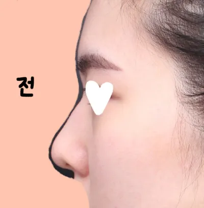 베리굿에서 수술 고민중이라면 고민말고 하세요!!!!