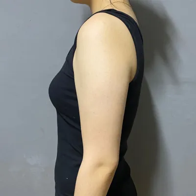 지방흡입 팔 반년차 후기!