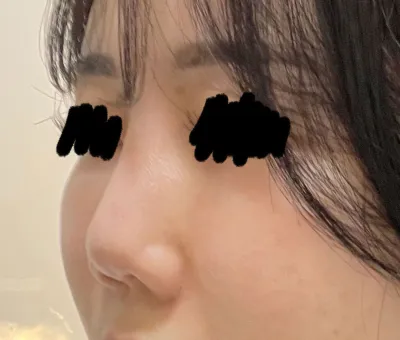 수술결과는 정말 대만족입니당 금손..원장님.. ^^*