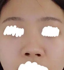 ​첫코수술 잘못되서 코가휘어있고 높이도 낮고 콧구멍도 짝짝이 총체적 난국 이였는데