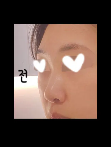 기능코로 수술한지 4개월 접어들고 있어요 ㅎㅎ