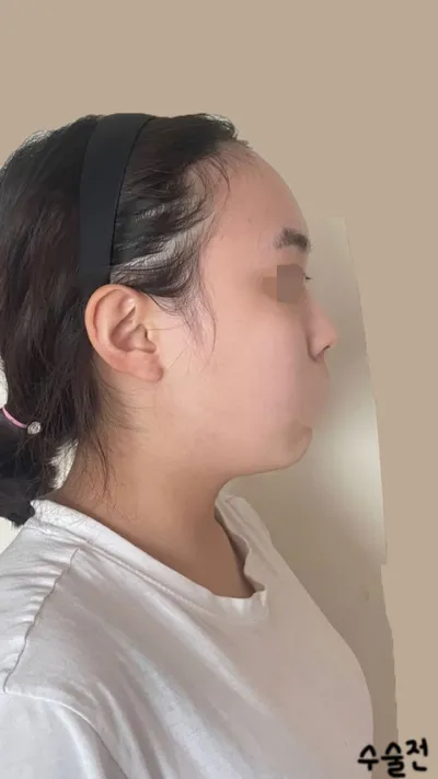 수술한지 3개월차후기입니다!