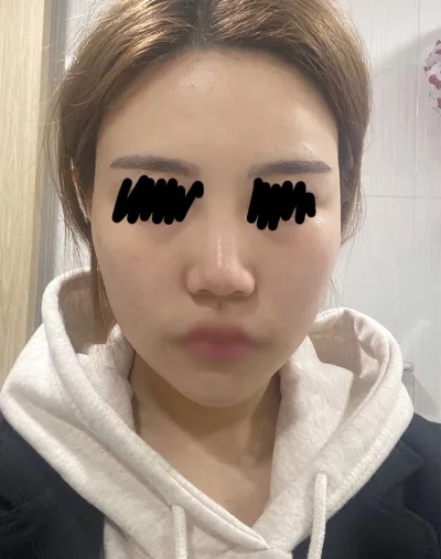 ​윤곽 3개월차 후기에용