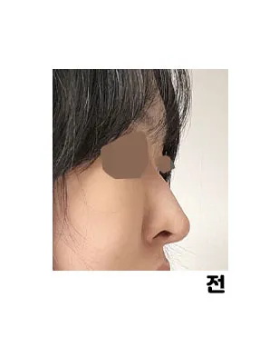 최근에 비염이 너무 심해져서 병원알아보다가상담받고 바로 수술예약했어요!