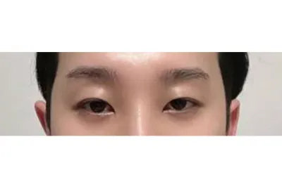 수술 6개월차 후기입니다.