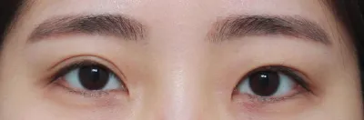 ​눈성형(눈재) 3개월차 후기,,,