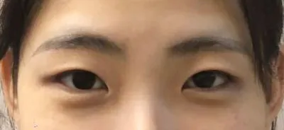 이번년도 4월 20일에 눈성형(첫눈) 쌍커풀(자연유착)과 눈매교정 비절개 방법 으로 쌍커풀 수술을 진행 하였습니다.