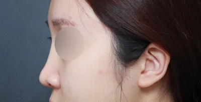 코 재수술을 알아보러 다닐때가 엊그제 같은데 벌써 시간이  훌쩍 지나서 6개월 정도 되어 가네요