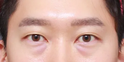 남자 눈밑지방재배치 후기입니다.