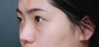 베리굿성형외과에서 코성형(첫코),융비술,절골,눈밑지방재배치 진행했습니당!