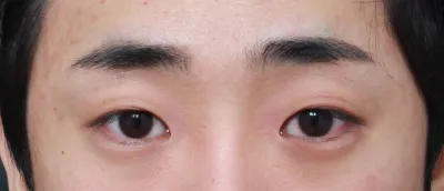 ​눈이 졸린눈이고 속눈썹이 계속 눈을 찔러서 결심하게 되었습니다.