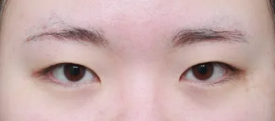 이번에 무쌍이였던 제가 눈성형(첫눈)을 했습니당..