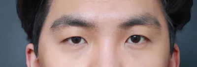 남자눈성형 이제 자신감이 생겼어요ㅎ