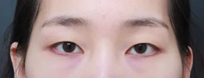 이전부터 계속 수술 고민했었는데 하길 너무 잘한 것 같아요!