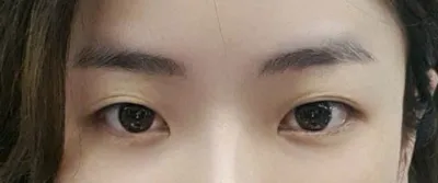 왜 절개를 생각했지 싶을정도로 또렷하고 너무 자연스러워요!