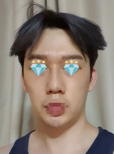 코성형 대박난 거같아요 ㅋㅋ