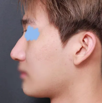 베리굿성형외과 에서 코수술 진행한지 한달차 후기입니다!