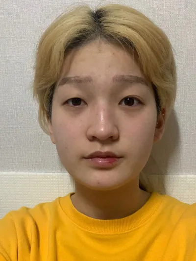 수술한지 4개월 , 화장이 필요 없어요!!