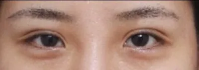 소세지 눈아 이제 안녕~​