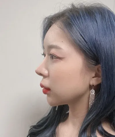 베리굿에서 매부리코 교정 9개월차 후기!