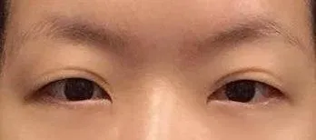 안녕하세요. 벌써 수술한지 6개월 지났네요.