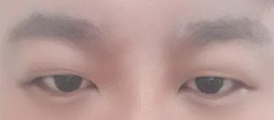 비절개눈매교정 수술했어요