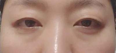 벌써 눈밑지방재배치수술한지 3개월넘었네요