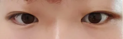 베리굿 성형외과 손원일 원장님 후기입니다.