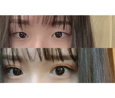 수술 전에 눈에 주름이 많이 져서 걱정했는데 진짜 딱 원하던대로 되었어요