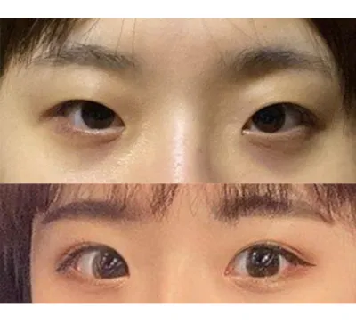 원래 눈은 답답해 보였는데 확실히 정말 답답한 느낌이 없어졌어요 진짜 만족해요!!