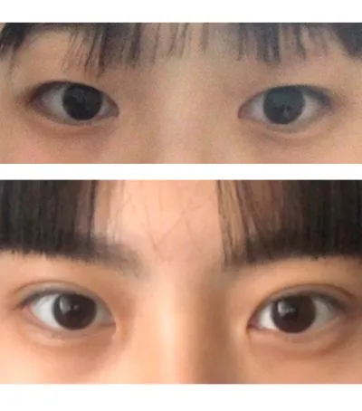 수술 후 사진은 쌍 수 한지 38일 정도 지난 눈입니다!