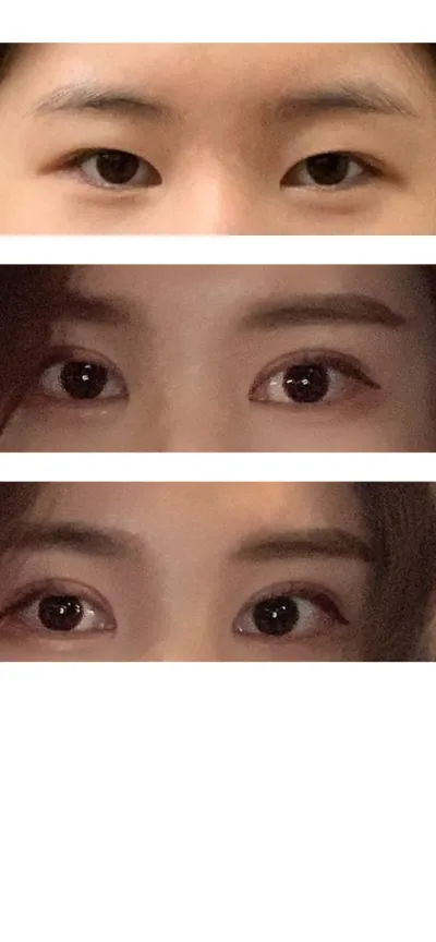쌍수 절개 눈재수술,뒷 밑트임(절개듀얼트임),절개눈매교정후기