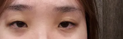 베리굿 성형외과에서 첫 눈 수술 받았습니다