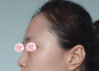 실장님도 원장님도 너무 친절하시고 콧대도 코끝도 맘에 듭니다 !!