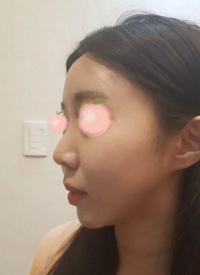 자가늑연골 코 했어요 현재 넘 만족하면서 지내고 있어요ㅋㅋㅋㅋ